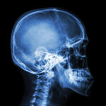 Understanding the Eggshell Skull Rule in Texas