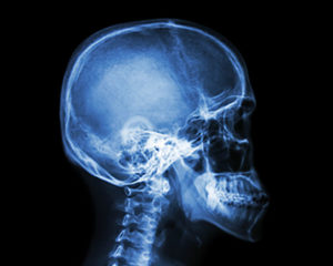 Understanding the Eggshell Skull Rule in Texas